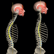 Kyphosis & Rounded Back